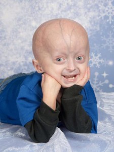 portador-de-progeria