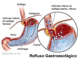 refluxogastroesofagico