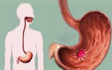 O Que É Ulcera – Como Tratar, Causas e Sintomas