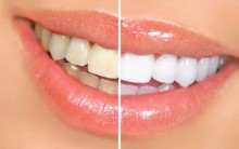 Como Ter os Dentes Mais Brancos – Dicas