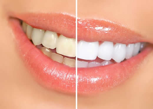 Como Ter os Dentes Mais Brancos – Dicas