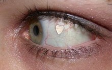 Implante de Jóias Nos Olhos – O Que É e Riscos