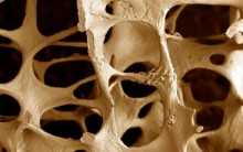 Osteoporose – O Que É e Como Prevenir