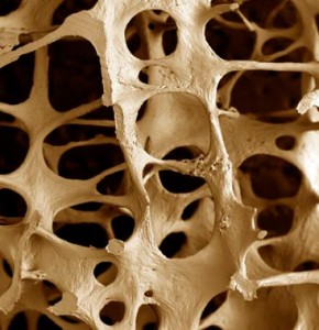 osteoporose-ossos