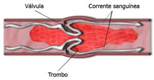 trombose-diagrama