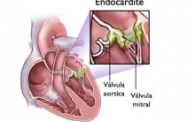 Endocardite Bacteriana – O que é – Sintomas – Tratamento