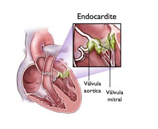 Endocardite Bacteriana – O que é – Sintomas – Tratamento