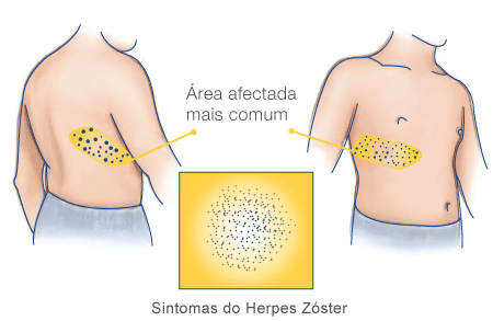 Herpes-Zoster-Area