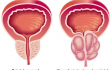 Hiperplasia Benigna da Próstata. O que é, Sintomas e Tratamento