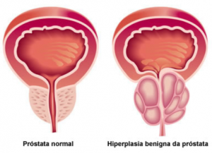 Hiperplasia Benigna da Próstata. Situação da Próstata