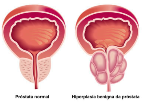 Hiperplasia Benigna da Próstata. O que é, Sintomas e Tratamento