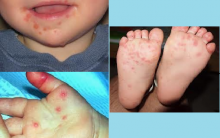 Doença Mão, Pé e Boca em Crianças – Sintomas e Tratamento