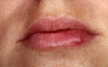 Espinhas nos Lábios – Causas e Como se Livrar