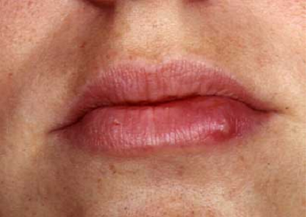 Espinhas nos Lábios – Causas e Como se Livrar