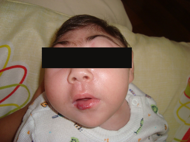 Microcefalia-nenem