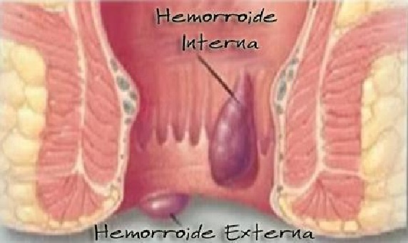 Hemorroidas – Causas, Sintomas e Como Tratar