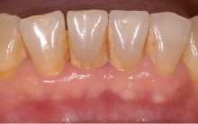 Como Remover Placa Bacteriana Dos Dentes – Dicas Caseiras
