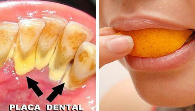 Como Remover Placa Bacteriana Dos Dentes