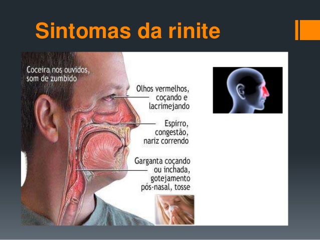 Sinusite e Rinite  Como Cuidar Receit