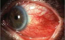 Esclerite Nos Olhos – O Que É – Sintomas e Causas