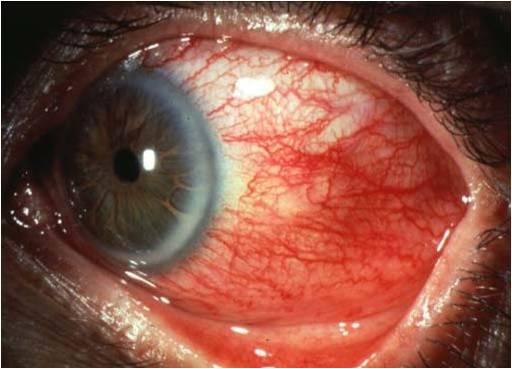 Esclerite nos olhos - O Que É - Sintomas e Causas