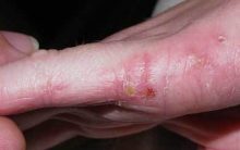 Psoriase e Eczema – Diferença e Como Tratar