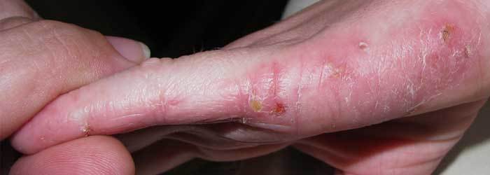 Psoriase e Eczema - Diferença e Como Tratar
