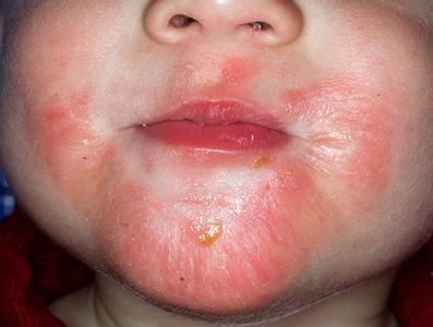 Psoriase e Eczema - Diferença e