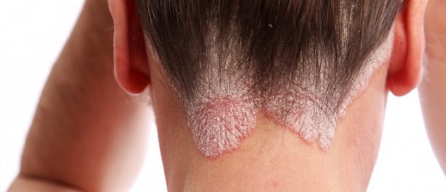 Psoriase e Eczema - Diferença