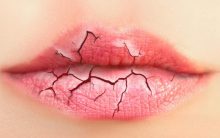 Lábios Rachados – Como Tratar