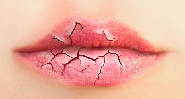 Lábios Rachados – Como Tratar