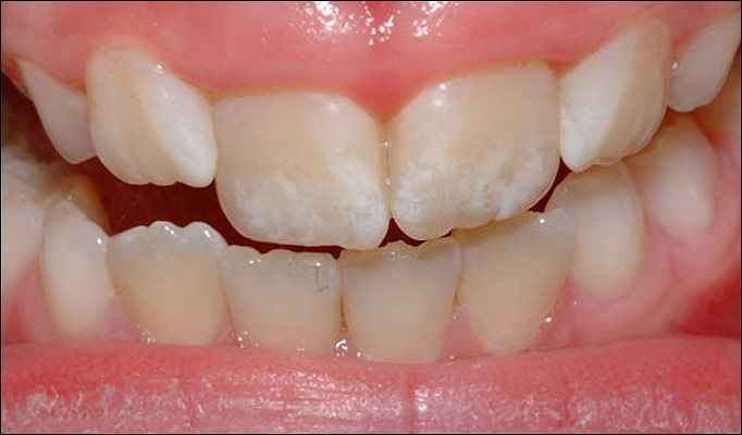 Fluorose Dentária Manchas Nos Dentes – Como Evitar