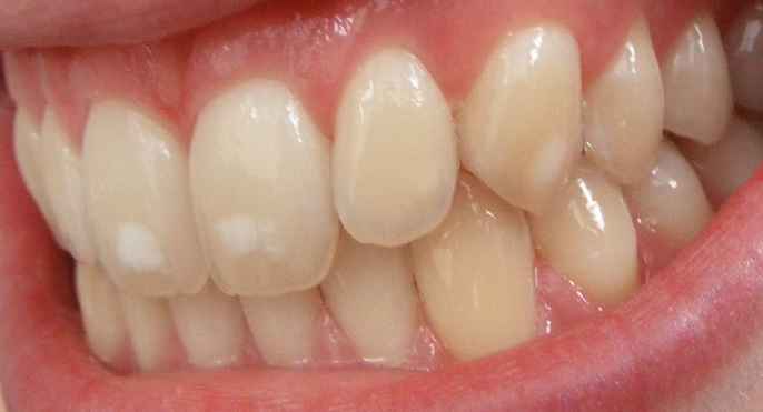 fluorose-dentaria-manchas-nos-dentes