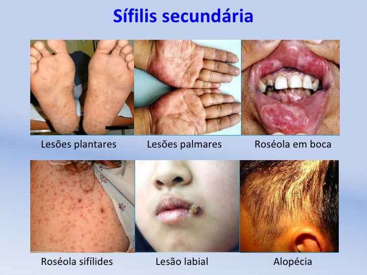 Sifilis Transmissao E Sintomas