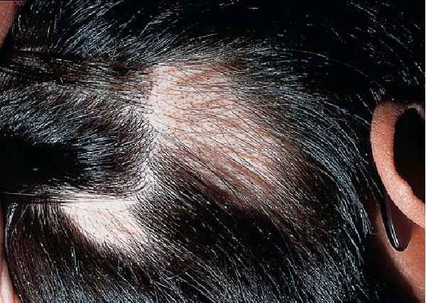 Alopecia - Causas e Tratamento
