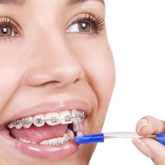 Aparelho Nos Dentes – O Que Não Comer