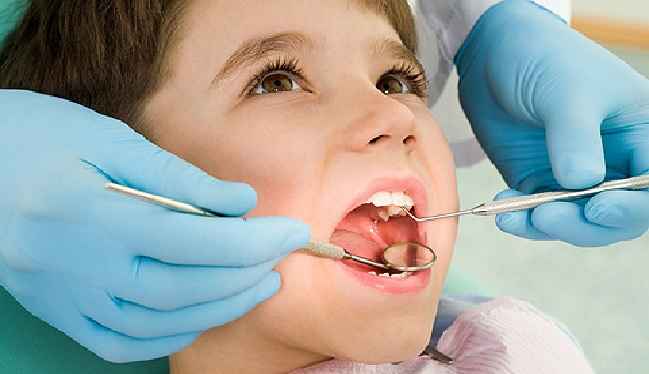 Selante Dental Para Crianças – Benefícios
