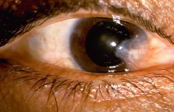 Catarata Nos Olhos - Sintomas, Causas e Tratamento