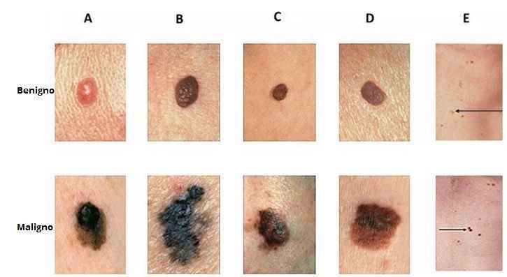 Melanoma Câncer de Pele - Tipos, Causas e Tratamentos