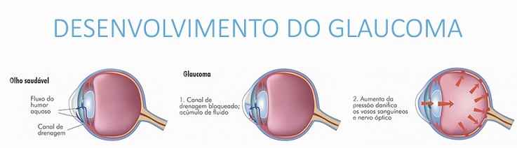 Glaucoma Doença No Nervo Óptico – Tipos e Sintomas e Tratamento