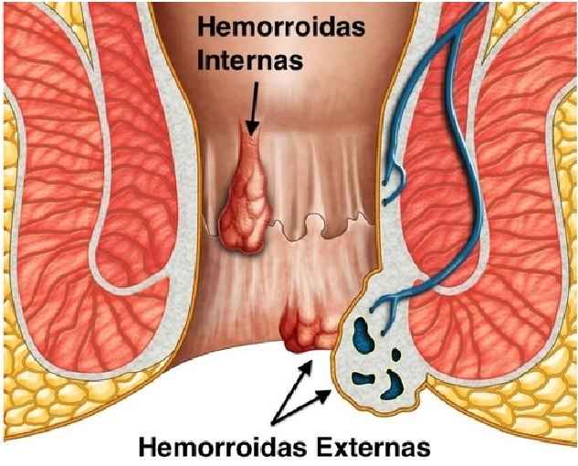 Tratamento de Hemorroidas – Remédios Caseiros