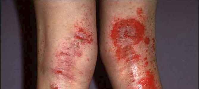 Dermatite Atópica – Causas, Sintomas e Como Prevenir
