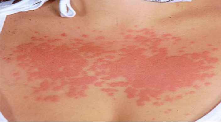 Alergia ao Calor – Sintomas e Como Evitar