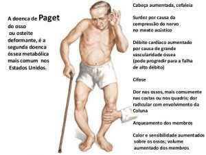 Doença de Paget Dos Ossos – Sintomas e Tratamento