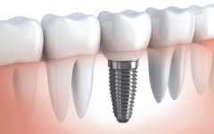 Implantes Dentários Gratuitos – Como Fazer
