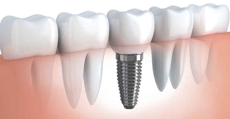 Implantes Dentários Gratuitos – Como Fazer