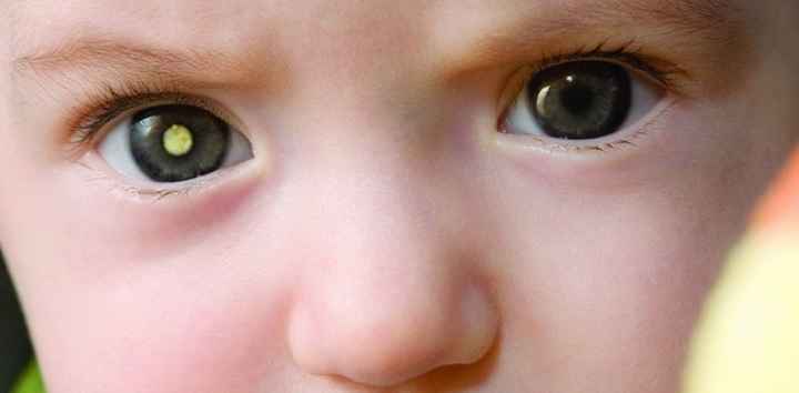 Retinoblastoma – Causas e Sintomas