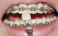 Clarear os Dentes – Momento Certo