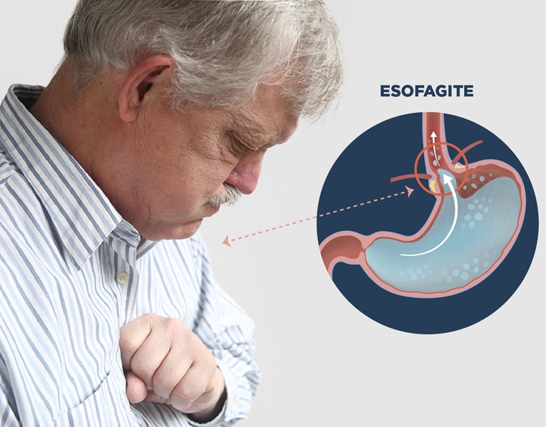 Inflamação do Esôfago a Esofagite - Tipos, Causas e Sintomas