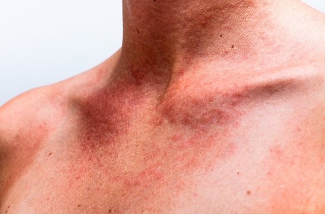 Alergia na Pele – Remédios Naturais